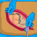 appendix surgery